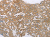 The image on the left is immunohistochemistry of paraffin-embedded Human breast cancer tissue using CSB-PA642637 (PDK4 Antibody) at dilution 1/50, on the right is treated with synthetic peptide. (Original magnification: ×200)