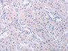 The image on the left is immunohistochemistry of paraffin-embedded Human lung cancer tissue using CSB-PA214505 (PKD2L1 Antibody) at dilution 1/40, on the right is treated with synthetic peptide. (Original magnification: ×200)