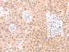 The image on the left is immunohistochemistry of paraffin-embedded Human lung cancer tissue using CSB-PA960366 (PKD2L1 Antibody) at dilution 1/25, on the right is treated with synthetic peptide. (Original magnification: ×200)