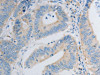 The image on the left is immunohistochemistry of paraffin-embedded Human colon cancer tissue using CSB-PA114989 (PDX1 Antibody) at dilution 1/30, on the right is treated with synthetic peptide. (Original magnification: ×200)