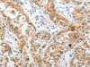 The image on the left is immunohistochemistry of paraffin-embedded Human lung cancer tissue using CSB-PA889657 (PIBF1 Antibody) at dilution 1/60, on the right is treated with synthetic peptide. (Original magnification: ×200)