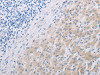The image on the left is immunohistochemistry of paraffin-embedded Human liver cancer tissue using CSB-PA023267 (PFN2 Antibody) at dilution 1/30, on the right is treated with synthetic peptide. (Original magnification: ×200)