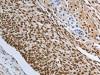 The image on the left is immunohistochemistry of paraffin-embedded Human cervical cancer tissue using CSB-PA948631 (PRMT3 Antibody) at dilution 1/30, on the right is treated with synthetic peptide. (Original magnification: ×200)