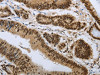 The image on the left is immunohistochemistry of paraffin-embedded Human colon cancer tissue using CSB-PA948631 (PRMT3 Antibody) at dilution 1/30, on the right is treated with synthetic peptide. (Original magnification: ×200)