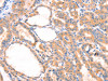 The image on the left is immunohistochemistry of paraffin-embedded Human thyroid cancer tissue using CSB-PA242653 (PRDX2 Antibody) at dilution 1/80, on the right is treated with synthetic peptide. (Original magnification: ×200)
