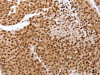 The image on the left is immunohistochemistry of paraffin-embedded Human breast cancer tissue using CSB-PA989924 (PTTG1 Antibody) at dilution 1/60, on the right is treated with synthetic peptide. (Original magnification: ×200)