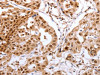 The image on the left is immunohistochemistry of paraffin-embedded Human lung cancer tissue using CSB-PA989924 (PTTG1 Antibody) at dilution 1/60, on the right is treated with synthetic peptide. (Original magnification: ×200)