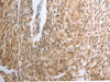The image on the left is immunohistochemistry of paraffin-embedded Human cervical cancer tissue using CSB-PA283902 (RAD51 Antibody) at dilution 1/30, on the right is treated with synthetic peptide. (Original magnification: ×200) The image on the left is immunohistochemistry of paraffin-embedded Human cervical cancer tissue using CSB-PA283902 (RAD51 Antibody) at dilution 1/30, on the right is treated with synthetic peptide. (Original magnification: ×200)