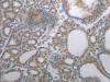 The image on the left is immunohistochemistry of paraffin-embedded Human thyroid cancer tissue using CSB-PA998451 (RBMS3 Antibody) at dilution 1/70, on the right is treated with synthetic peptide. (Original magnification: ×200)