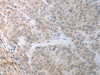 The image on the left is immunohistochemistry of paraffin-embedded Human liver cancer tissue using CSB-PA998451 (RBMS3 Antibody) at dilution 1/70, on the right is treated with synthetic peptide. (Original magnification: ×200)