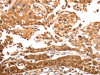 The image on the left is immunohistochemistry of paraffin-embedded Human lung cancer tissue using CSB-PA559833 (SLC39A6 Antibody) at dilution 1/30, on the right is treated with synthetic peptide. (Original magnification: ×200)