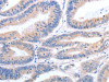 The image on the left is immunohistochemistry of paraffin-embedded Human colon cancer tissue using CSB-PA271998 (GFRA4 Antibody) at dilution 1/40, on the right is treated with synthetic peptide. (Original magnification: ×200)