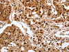 The image on the left is immunohistochemistry of paraffin-embedded Human lung cancer tissue using CSB-PA555646 (SRF Antibody) at dilution 1/30, on the right is treated with synthetic peptide. (Original magnification: ×200)