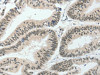 The image on the left is immunohistochemistry of paraffin-embedded Human colon cancer tissue using CSB-PA230499 (HNF1B Antibody) at dilution 1/80, on the right is treated with synthetic peptide. (Original magnification: ×200)