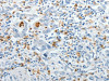 The image on the left is immunohistochemistry of paraffin-embedded Human gastic cancer tissue using CSB-PA294602 (TOP1MT Antibody) at dilution 1/10, on the right is treated with synthetic peptide. (Original magnification: ×200)
