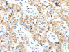 The image on the left is immunohistochemistry of paraffin-embedded Human lung cancer tissue using CSB-PA140509 (NTRK1 Antibody) at dilution 1/30, on the right is treated with synthetic peptide. (Original magnification: ×200)
