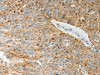 The image on the left is immunohistochemistry of paraffin-embedded Human ovarian cancer tissue using CSB-PA129196 (COL4A3 Antibody) at dilution 1/20, on the right is treated with synthetic peptide. (Original magnification: ×200)