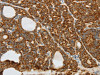 The image on the left is immunohistochemistry of paraffin-embedded Human thyroid cancer tissue using CSB-PA129196 (COL4A3 Antibody) at dilution 1/20, on the right is treated with synthetic peptide. (Original magnification: ×200)