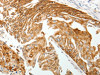 The image on the left is immunohistochemistry of paraffin-embedded Human cervical cancer tissue using CSB-PA562700 (TMSB10 Antibody) at dilution 1/15, on the right is treated with synthetic peptide. (Original magnification: ×200)