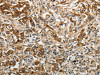 The image on the left is immunohistochemistry of paraffin-embedded Human gastric cancer tissue using CSB-PA992754 (YBX1 Antibody) at dilution 1/15, on the right is treated with synthetic peptide. (Original magnification: ×200)