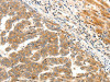 The image on the left is immunohistochemistry of paraffin-embedded Human liver cancer tissue using CSB-PA463798 (LPAR5 Antibody) at dilution 1/25, on the right is treated with synthetic peptide. (Original magnification: ×200)