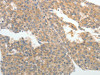 The image on the left is immunohistochemistry of paraffin-embedded Human liver cancer tissue using CSB-PA437890 (ABCB11 Antibody) at dilution 1/25, on the right is treated with synthetic peptide. (Original magnification: ×200)