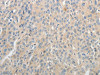 The image on the left is immunohistochemistry of paraffin-embedded Human ovarian cancer tissue using CSB-PA437890 (ABCB11 Antibody) at dilution 1/25, on the right is treated with synthetic peptide. (Original magnification: ×200)