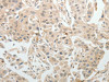 The image on the left is immunohistochemistry of paraffin-embedded Human ovarian cancer tissue using CSB-PA447968 (ABCB11 Antibody) at dilution 1/15, on the right is treated with synthetic peptide. (Original magnification: ×200)