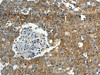 The image on the left is immunohistochemistry of paraffin-embedded Human breast cancer tissue using CSB-PA112004 (ABCC10 Antibody) at dilution 1/30, on the right is treated with synthetic peptide. (Original magnification: ×200)