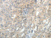 The image on the left is immunohistochemistry of paraffin-embedded Human ovarian cancer tissue using CSB-PA112004 (ABCC10 Antibody) at dilution 1/30, on the right is treated with synthetic peptide. (Original magnification: ×200)