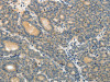 The image on the left is immunohistochemistry of paraffin-embedded Human thyroid cancer tissue using CSB-PA582291 (ABCC12 Antibody) at dilution 1/10, on the right is treated with synthetic peptide. (Original magnification: ×200)