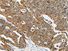 The image on the left is immunohistochemistry of paraffin-embedded Human ovarian cancer tissue using CSB-PA909687 (ABCD2 Antibody) at dilution 1/20, on the right is treated with synthetic peptide. (Original magnification: ×200)