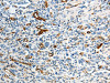 The image on the left is immunohistochemistry of paraffin-embedded Human gastic cancer tissue using CSB-PA127583 (ABCG1 Antibody) at dilution 1/40, on the right is treated with synthetic peptide. (Original magnification: ×200)