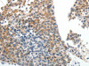 The image on the left is immunohistochemistry of paraffin-embedded Human liver cancer tissue using CSB-PA935474 (ABCG5 Antibody) at dilution 1/20, on the right is treated with synthetic peptide. (Original magnification: ×200)