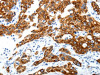 The image on the left is immunohistochemistry of paraffin-embedded Human lung cancer tissue using CSB-PA281021 (ABI3BP Antibody) at dilution 1/25, on the right is treated with synthetic peptide. (Original magnification: ×200)