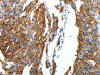 The image on the left is immunohistochemistry of paraffin-embedded Human ovarian cancer tissue using CSB-PA281021 (ABI3BP Antibody) at dilution 1/25, on the right is treated with synthetic peptide. (Original magnification: ×200)