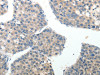 The image on the left is immunohistochemistry of paraffin-embedded Human liver cancer tissue using CSB-PA970308 (ABI3BP Antibody) at dilution 1/20, on the right is treated with synthetic peptide. (Original magnification: ×200)