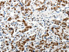 The image on the left is immunohistochemistry of paraffin-embedded Human gastric cancer tissue using CSB-PA970308 (ABI3BP Antibody) at dilution 1/20, on the right is treated with synthetic peptide. (Original magnification: ×200)