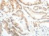 The image on the left is immunohistochemistry of paraffin-embedded Human colon cancer tissue using CSB-PA119696 (ABL2 Antibody) at dilution 1/25, on the right is treated with synthetic peptide. (Original magnification: ×200)