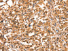 The image on the left is immunohistochemistry of paraffin-embedded Human thyroid cancer tissue using CSB-PA045809 (ACADVL Antibody) at dilution 1/15, on the right is treated with synthetic peptide. (Original magnification: ×200)