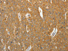 The image on the left is immunohistochemistry of paraffin-embedded Human ovarian cancer tissue using CSB-PA204064 (AKR1B1 Antibody) at dilution 1/40, on the right is treated with synthetic peptide. (Original magnification: ×200)