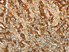 The image on the left is immunohistochemistry of paraffin-embedded Human gastric cancer tissue using CSB-PA204064 (AKR1B1 Antibody) at dilution 1/40, on the right is treated with synthetic peptide. (Original magnification: ×200)