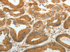 The image on the left is immunohistochemistry of paraffin-embedded Human colon cancer tissue using CSB-PA188838 (AKR1C1 Antibody) at dilution 1/30, on the right is treated with synthetic peptide. (Original magnification: ×200)