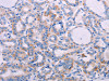 The image on the left is immunohistochemistry of paraffin-embedded Human thyroid cancer tissue using CSB-PA959270 (AGT Antibody) at dilution 1/30, on the right is treated with synthetic peptide. (Original magnification: ×200)