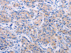 The image on the left is immunohistochemistry of paraffin-embedded Human lung cancer tissue using CSB-PA693559 (AGT Antibody) at dilution 1/50, on the right is treated with synthetic peptide. (Original magnification: ×200)