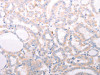 The image on the left is immunohistochemistry of paraffin-embedded Human thyroid cancer tissue using CSB-PA779568 (ANKRA2 Antibody) at dilution 1/50, on the right is treated with synthetic peptide. (Original magnification: ×200)