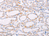 The image on the left is immunohistochemistry of paraffin-embedded Human thyroid cancer tissue using CSB-PA432470 (ANKRD26 Antibody) at dilution 1/25, on the right is treated with synthetic peptide. (Original magnification: ×200)