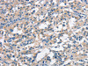 The image on the left is immunohistochemistry of paraffin-embedded Human thyroid cancer tissue using CSB-PA325565 (ANAPC1 Antibody) at dilution 1/30, on the right is treated with synthetic peptide. (Original magnification: ×200)
