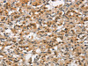 The image on the left is immunohistochemistry of paraffin-embedded Human thyroid cancer tissue using CSB-PA959149 (ANAPC4 Antibody) at dilution 1/30, on the right is treated with synthetic peptide. (Original magnification: ×200)