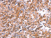 The image on the left is immunohistochemistry of paraffin-embedded Human thyroid cancer tissue using CSB-PA165039 (APMAP Antibody) at dilution 1/30, on the right is treated with synthetic peptide. (Original magnification: ×200)